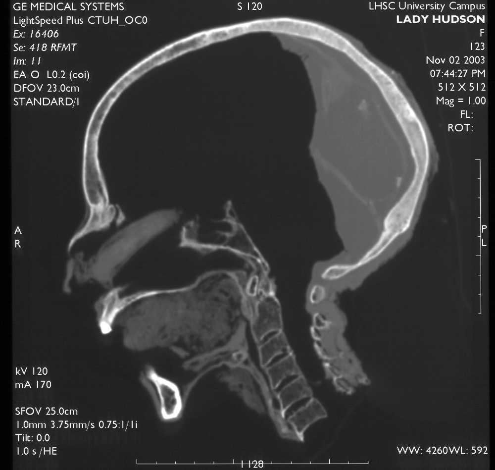A CT slice through the midline of the head of a mummy&mdash;Lady Hudson&mdash;showing that her brain was removed through her nose and resin poured into the rear of the skull. Image courtesy of Andrew Nelson, University of Western Ontario.